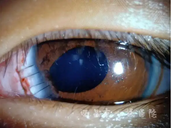 我院眼科成功救治一名眼外伤儿童