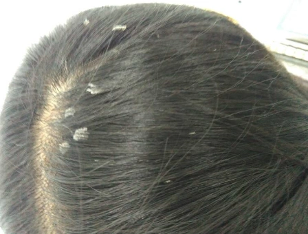 一天不洗头头发能掉一层头皮屑三个小秘诀让你告别头皮屑烦恼