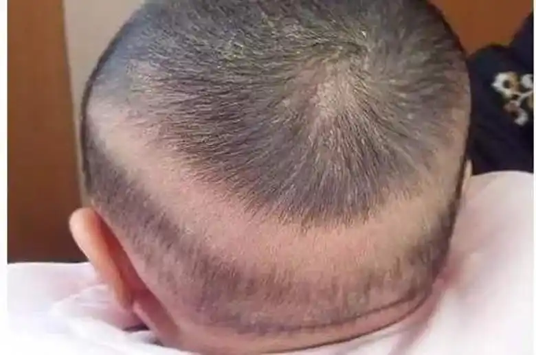 你有同款的枕秃宝宝吗?听说是缺钙啊?