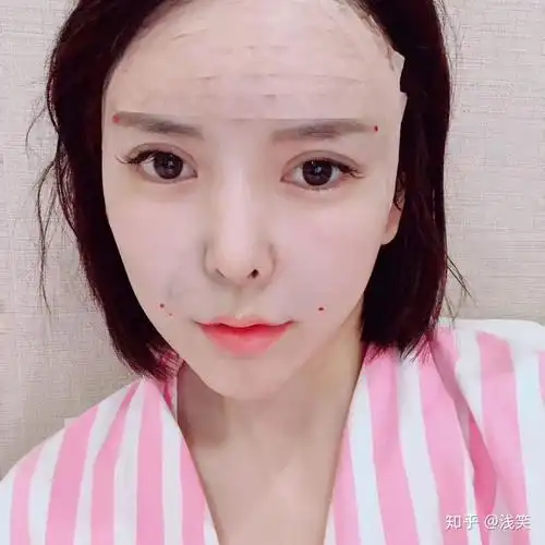 全脸脂肪填充一个月以后精致的反馈图