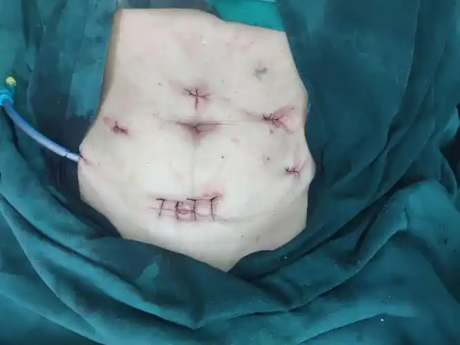 我科已独立完成腹腔镜下结肠癌,直肠癌,胃癌,腹腔镜下脾脏切除等手术