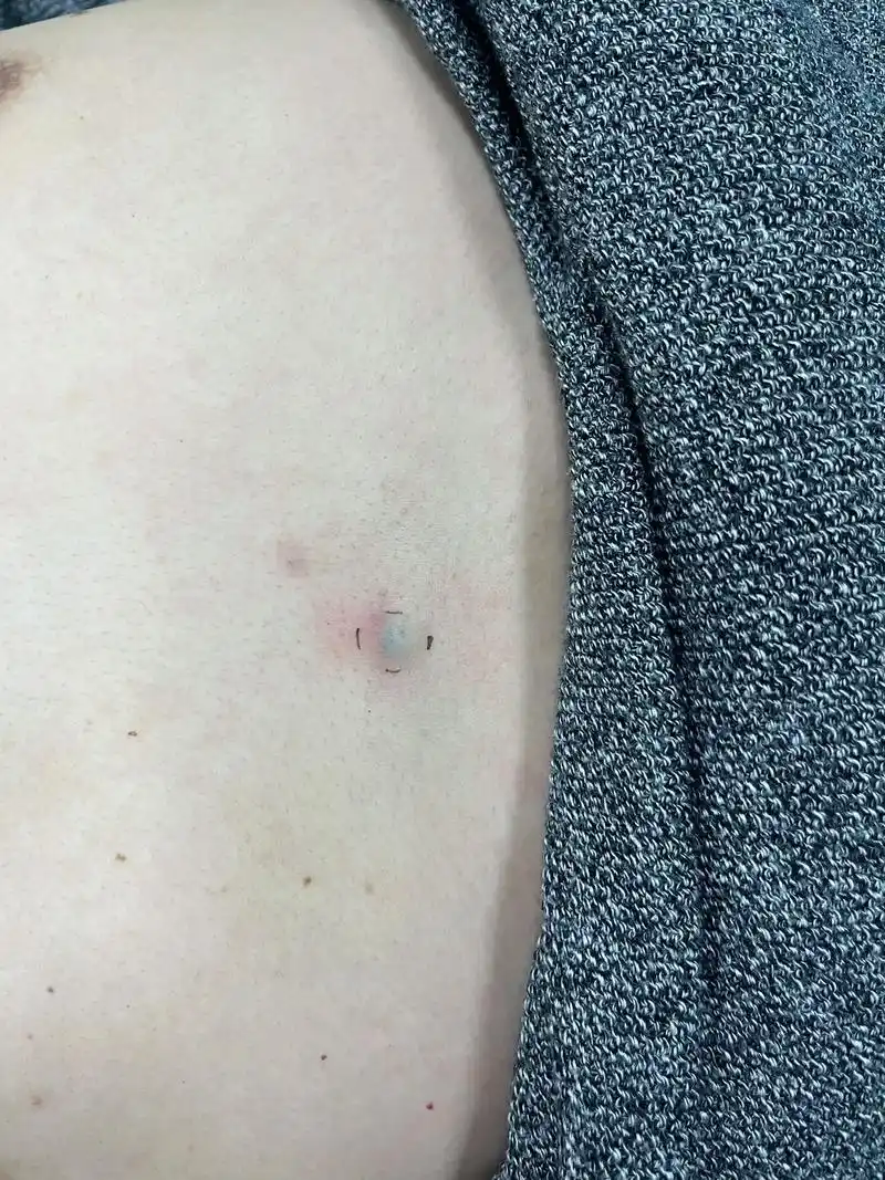 皮脂腺囊肿.#手术室日常  皮脂腺囊肿俗称"粉瘤",好发于前 - 抖音