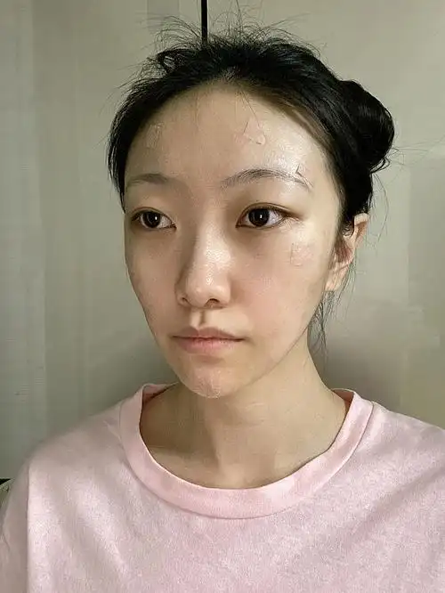 【术后第七天】自体脂肪填充术后第七天