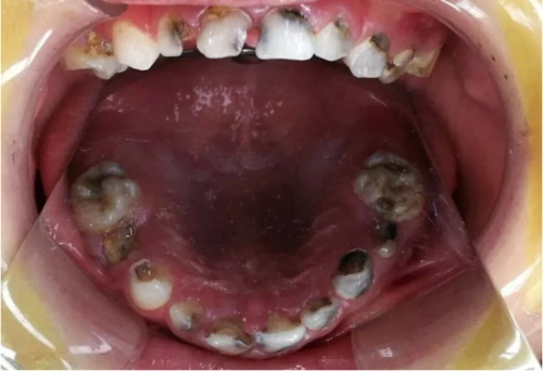 10个孩子5个长双排牙大多是乳牙蛀牙不重视引起的