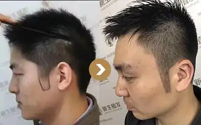 鬓角种植和植发一样,是通过精细的显微外科手术提取出后枕部健康的