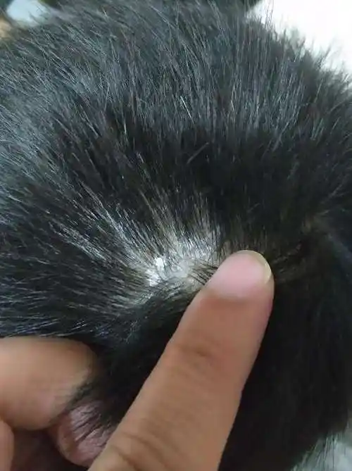 头皮上有一块一块的结疤白色和黄色扣掉后那块头皮是红色的