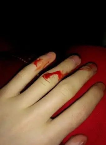 手出血的图片61