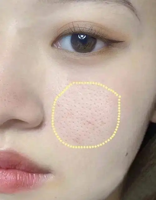 毛孔粗大?试试我的修复秘籍!