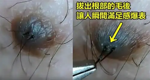 日本网友在用镍夹猛扯黑痣上的毛,看到最后感觉全身都松散了.崩溃阿!