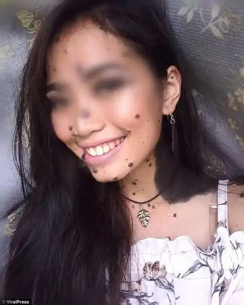 女子长满黑痣却人美歌甜 不惧嘲讽要当环球小姐