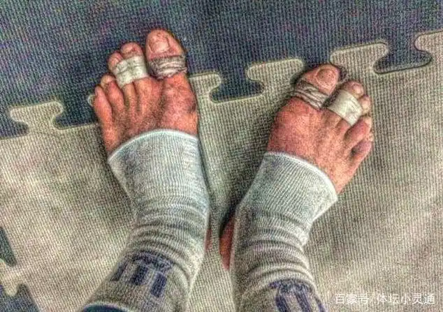邱建良2个脚趾绑在一块