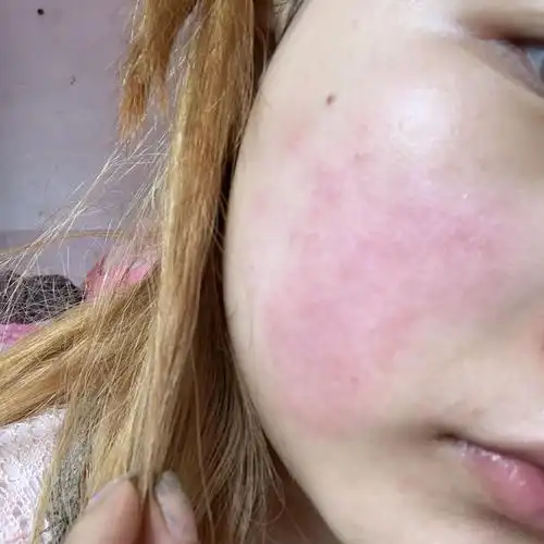 有谁知道这个脸怎么回事 过敏吗