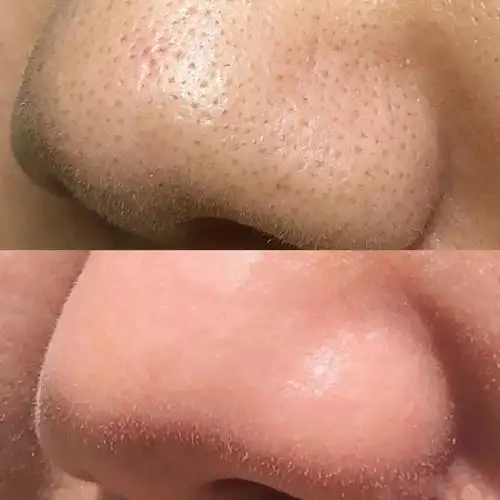 到美容院去黑头多少钱?