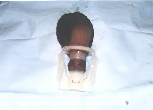 几例环扎压榨型包皮环切术