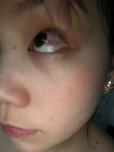 眼睛里不知道怎么回事有很多红血丝!每天盯着电脑