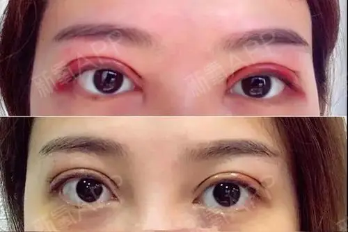 双眼皮好不好_效果图_猪猪女孩ok切开双眼皮术后第7天_新氧美容整形