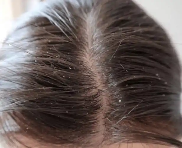 日常生活中如何缓解头皮瘙痒许多头皮屑的现象呢