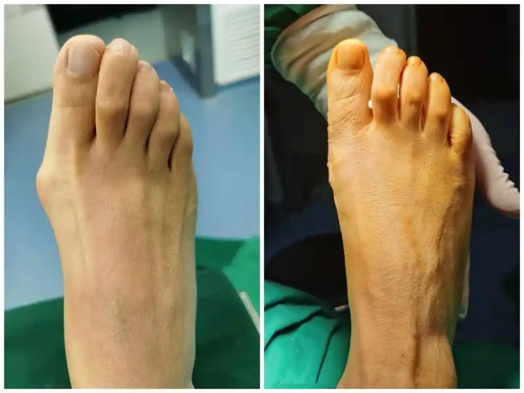 微创治疗拇外翻 从此告别大脚骨