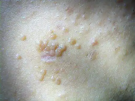 面部有一点肉疙瘩 求高手来回答啊 还有怎样除去