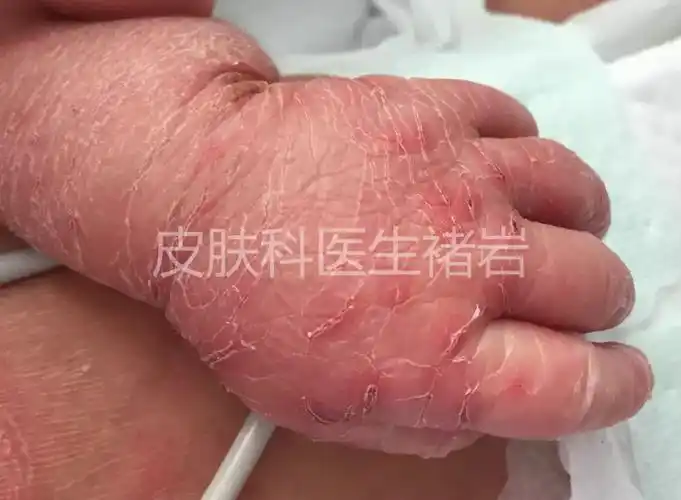 有些过期产或胎盘功能不良的宝宝,甚至会表现为大片的膜状脱屑,有时在