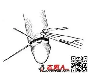 包皮手术过程全揭秘【图】 / 比乐族
