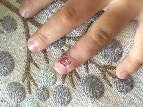 孩子手指上起泡,而后结痂,请医生朋友给看看.