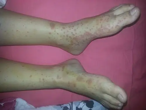 荨麻疹性血管炎症状_血管炎_北京京城皮肤病医院(北京医保定点机构)