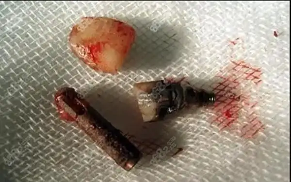 花了5万种植牙的亲身体验分享,40岁种植牙失败太痛苦了