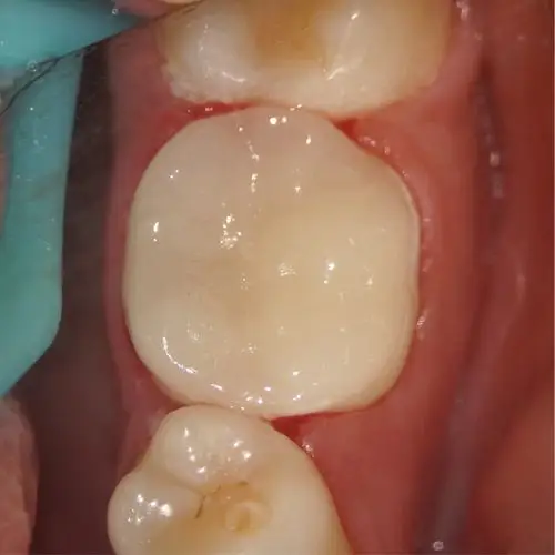 牙体牙髓一体化治疗下颌第一磨牙慢性牙髓炎患者一例