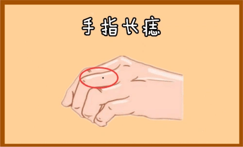 食指长痣,说明贵人是自己的兄弟姐妹;中指长痣,贵人就是自己,与自己的