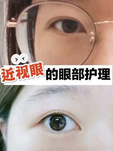 600度近视眼摘掉眼镜后如何快速拥有迷人大眼