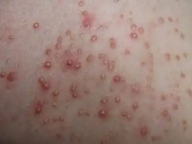 毛囊炎最好的治疗方法是什么