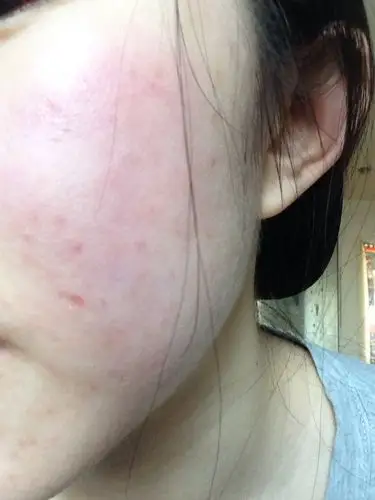 我的脸过敏啦,怎么办啊吃雷他定也不好使_百度知道