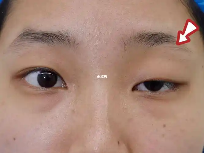 左眼先天性的睁不开 比较影影响外貌_外貌_上睑下垂_美妆_医美整形