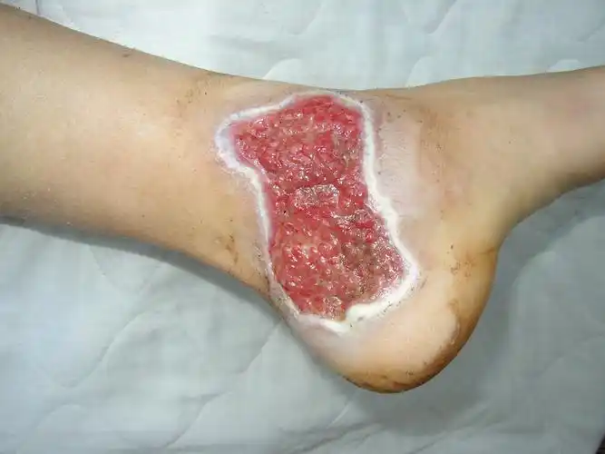 外伤后金葡菌感染伤口1例--经典案例分享