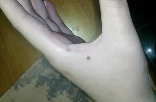 女人左手虎口有痣好不好 女人左手虎口有痣该不该去掉