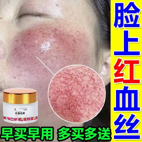 邹润安去皮肤红血丝修复角质层薄敏感肌修复面部泛红复去除红皮肤血丝