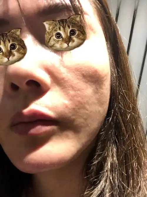 面部吸脂大坑,神经受损,身体大面积凹凸不平,下巴歪