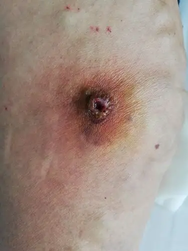 患者刚住院时静脉曲张伴溃疡,不断有脓性分泌物渗出