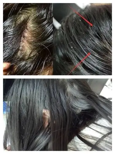 无数螨虫在啃食你的头皮难怪头发出油掉发,还痒的抓狂!