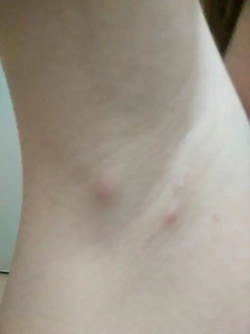 前几天腋下长了个疙瘩,硬硬的,按着有点痛,过两天旁边又长了个小的.