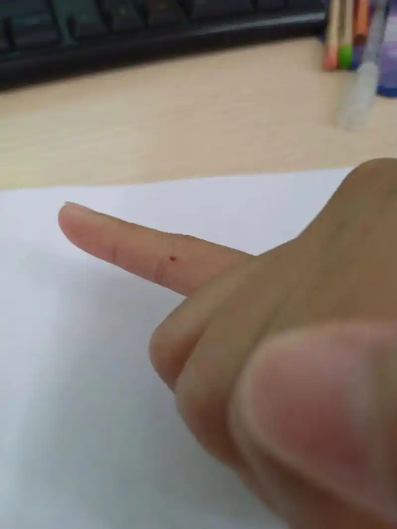 小拇指突然长了个痣