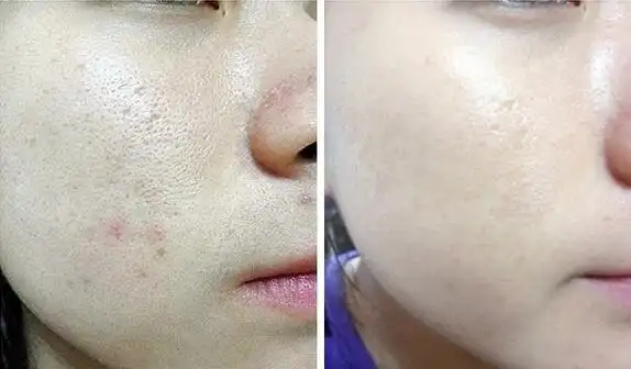 (毛孔缩小前,后对比图)