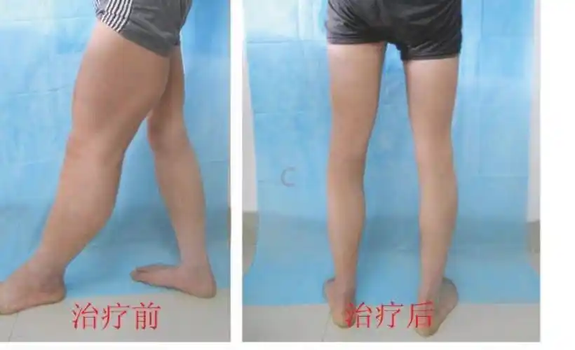 湖北哪个医院看象皮腿_什么是医药,保养是什么病-济南106医院