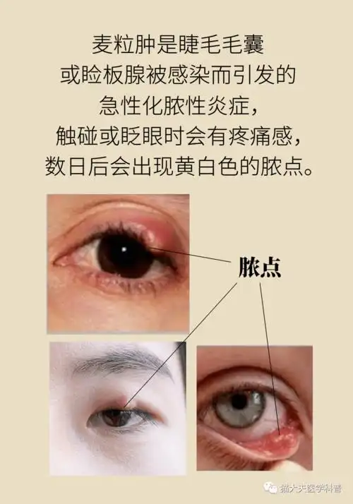 爱长针眼,咋整?