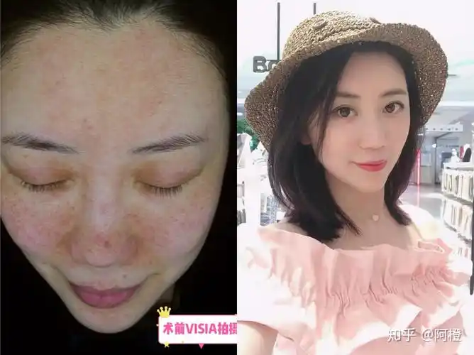 激光祛红血丝到底靠谱吗