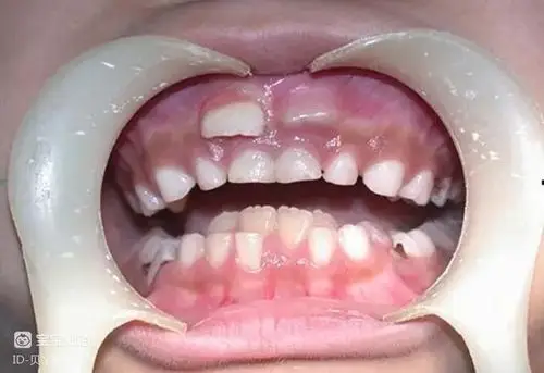 孩子出现双排牙需不需要将乳牙拔掉医生提醒要视情况而定