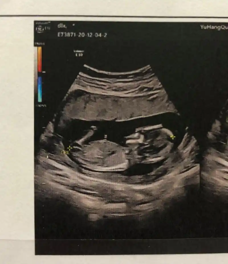 会有看nt的图的进～90牛宝宝 第一张是12周nt图 .