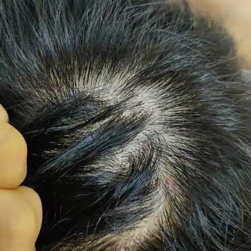 家人们有没有治毛囊炎的办法