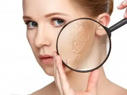 玫瑰痤疮洗脸后,脸干到紧绷,过会又变油腻.该怎么办?